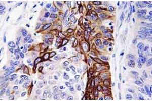 Immunohistochemistry analysis of GLUT4 / SLC2A4 antibody in paraffin-embedded human lung carcinoma tissue. (GLUT4 Antikörper)