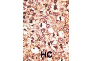 Formalin-fixed and paraffin-embedded human hepatocellular carcinoma tissue reacted with CRY1 polyclonal antibody  , which was peroxidase-conjugated to the secondary antibody, followed by AEC staining. (CRY1 Antikörper  (C-Term))