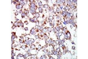 IHC analysis of FFPE human hepatocarcinoma tissue stained with the TAK1 antibody