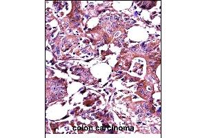 LGALS3 Antibody (C-term) ((ABIN657647 and ABIN2846642))immunohistochemistry analysis in formalin fixed and paraffin embedded human colon carcinoma followed by peroxidase conjugation of the secondary antibody and DAB staining. (Galectin 3 Antikörper  (C-Term))
