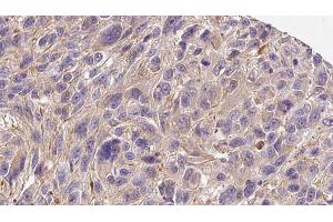 ABIN6272278 at 1/100 staining Human Melanoma tissue by IHC-P. (COL4a6 Antikörper  (Internal Region))