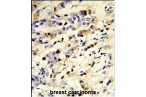 Formalin-fixed and paraffin-embedded human breast carcinoma reacted with IGHM Antibody (N-term), which was peroxidase-conjugated to the secondary antibody, followed by DAB staining. (IGHM Antikörper  (N-Term))