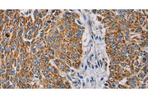Immunohistochemistry of paraffin-embedded Human lung cancer using MTFP1 Polyclonal Antibody at dilution of 1:30 (Mtfp1 Antikörper)