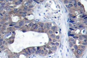Immunohistochemistry (IHC) analyzes of IRS-1 antibdoy in paraffin-embedded human breast carcinoma tissue. (IRS1 Antikörper)