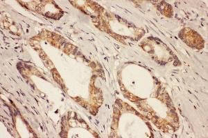 Anti-RAB8A antibody, IHC(P) IHC(P): Human Intestinal Cancer Tissue