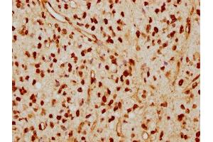 IHC image of ABIN7127601 diluted at 1:115 and staining in paraffin-embedded human glioma cancer performed on a Leica BondTM system. (Rekombinanter Lamin A/C Antikörper)