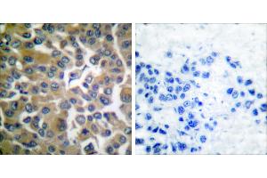 Peptide - +Immunohistochemical analysis of paraffin-embedded human breast carcinoma tissue, using FAP-1 antibody. (FAP Antikörper)