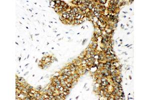 Anti-Calbindin Picoband antibody,  IHC(P): Human Mammary Cancer Tissue