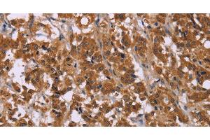 Immunohistochemistry of paraffin-embedded Human thyroid cancer using CMTM6 Polyclonal Antibody at dilution of 1:30 (CMTM6 Antikörper)