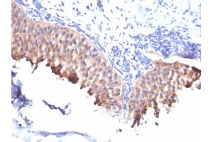 Formalin-fixed, paraffin-embedded human Bladder Carcinoma stained with Cytokeratin 10 Mouse Monoclonal Antibody (SPM261).