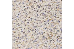 Immunohistochemistry of paraffin-embedded human kidney cancer using GJC2 antibody (ABIN5971490) at dilution of 1/200 (40x lens). (GJC2 Antikörper)