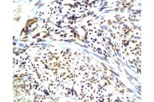 Formalin-fixed and paraffin embedded human endometrium carcinoma with Anti-CGRP/CGRP2 Polyclonal Antibody, Unconjugated (ABIN728218) at 1:200, followed by conjugation to the secondary antibody and DAB staining (CGRP Antikörper  (AA 65-130))