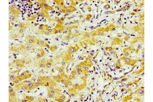 Immunohistochemistry of paraffin-embedded human liver cancer using ABIN7170696 at dilution of 1:100 (SND1 Antikörper  (AA 560-732))
