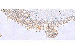 Immunohistochemistry of paraffin-embedded Human prost ate cancer tissue using GPCPD1 Polyclonal Antibody at dilution of 1:55(x200) (GPCPD1 Antikörper)