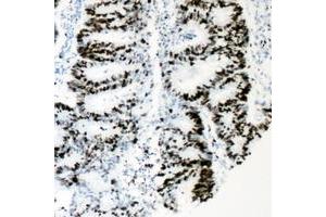 Immunohistochemical analysis of HNF4 alpha (pS313) staining in human colon cancer formalin fixed paraffin embedded tissue section. (HNF4A Antikörper  (pSer313))