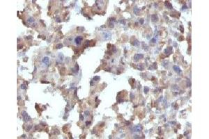 Formalin-fixed, paraffin-embedded human Histiocytoma stained with TNF alpha antibody (TNFA/1172) (TNF alpha Antikörper)