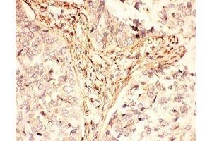IHC-P: LIF antibody testing of human lung cancer tissue (LIF Antikörper  (AA 23-202))