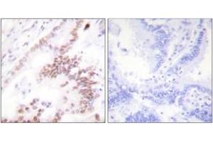 Immunohistochemistry analysis of paraffin-embedded human lung carcinoma tissue, using p300 Antibody.