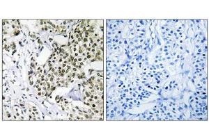Immunohistochemistry analysis of paraffin-embedded human breast carcinoma tissue using CAGE1 antibody. (CAGE1 Antikörper  (C-Term))