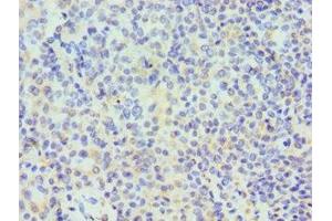 Immunohistochemistry of paraffin-embedded human breast cancer using ABIN7171508 at dilution of 1:100 (TARDBP Antikörper  (AA 1-260))