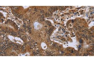 Immunohistochemistry of paraffin-embedded Human colon cancer using FHIT Polyclonal Antibody at dilution of 1:30 (FHIT Antikörper)