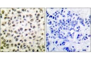 Immunohistochemistry analysis of paraffin-embedded human breast carcinoma tissue, using STAT5B (Ab-731) Antibody.
