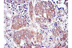 Immunohistochemical analysis of paraffin-embedded breast cancer tissues using MAPK3 mouse mAb with DAB staining.