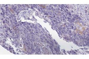 ABIN6279509 at 1/100 staining Human Head and neck cancer tissue by IHC-P. (KCNJ13 Antikörper  (Internal Region))