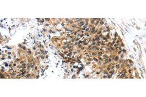 Immunohistochemistry of paraffin-embedded Human esophagus cancer tissue using TRIM74 Polyclonal Antibody at dilution 1:45 (TRIM74 Antikörper)