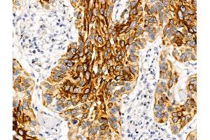 ABIN6262775 and ABIN6269025 at 1/100 staining Human esophageal cancer by IHC-P. (KRT16 Antikörper  (C-Term))