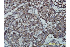 Immunoperoxidase of monoclonal antibody to GPR3 on formalin-fixed paraffin-embedded human transitional cell carcinoma tissue. (GPR3 Antikörper  (AA 1-330))