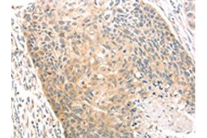 The image on the left is immunohistochemistry of paraffin-embedded Human esophagus cancer tissue using ABIN7130971(SCAP Antibody) at dilution 1/20, on the right is treated with fusion protein. (SREBF chaperone Antikörper)