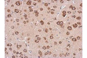 IHC-P Image Immunohistochemical analysis of paraffin-embedded CL1-5 xenograft, using cystatin F, antibody at 1:500 dilution. (CST7 Antikörper)