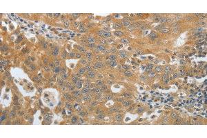 Immunohistochemistry of paraffin-embedded Human ovarian cancer using Amphiphysin I Polyclonal Antibody at dilution of 1:30 (Amphiphysin Antikörper)
