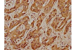 IHC image of ABIN7174271 diluted at 1:400 and staining in paraffin-embedded human liver cancer performed on a Leica BondTM system. (USP17L5 Antikörper  (C-Term))