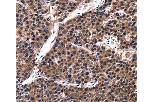 Immunohistochemistry of Human liver cancer using CUL4A Polyclonal Antibody at dilution of 1:62 (Cullin 4A Antikörper)