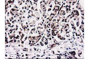 Immunohistochemical staining of paraffin-embedded Adenocarcinoma of Human colon tissue using anti-FAM40A mouse monoclonal antibody. (STRIP1 Antikörper)