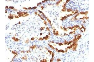 Formalin-fixed, paraffin-embedded human lung carcinoma stained with Cytokeratin 18 antibody (KRT18/835). (Cytokeratin 18 Antikörper)