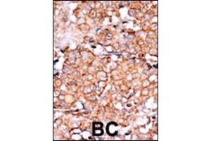 Formalin-fixed and paraffin-embedded human cancer tissue reacted with the primary antibody, which was peroxidase-conjugated to the secondary antibody, followed by AEC staining. (RAD9A Antikörper  (pSer328))