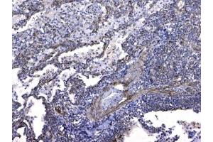 IHC testing of FFPE human lung cancer tissue with GSTM3 antibody at 1ug/ml.