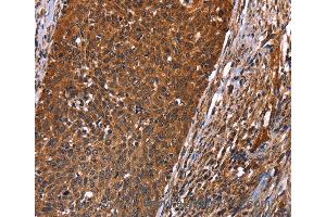 Immunohistochemistry of Human colon cancer using GUK1 Polyclonal Antibody at dilution of 1:40