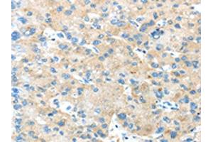 The image on the left is immunohistochemistry of paraffin-embedded Human liver cancer tissue using ABIN7189804(ANGPTL5 Antibody) at dilution 1/25, on the right is treated with synthetic peptide. (ANGPTL5 Antikörper)