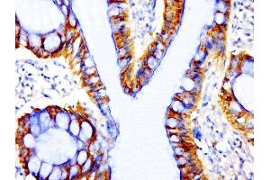 Paraformaldehyde-fixed, paraffin embedded human colon cancer, Antigen retrieval by boiling in sodium citrate buffer (pH6. (beta Catenin Antikörper  (pSer33))