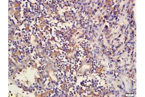 Formalin-fixed and paraffin embedded human laryngeal tissue  labeled with Rabbit Anti-DcR2/TNFRSF10D Polyclonal Antibody, Unconjugated (ABIN733088) at 1:200 followed by conjugation to the secondary antibody and DAB staining (DcR2 Antikörper)