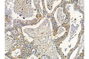 ABIN6261318 and ABIN6266877 at 1/100 staining human pancreatic cancer by IHC-P.