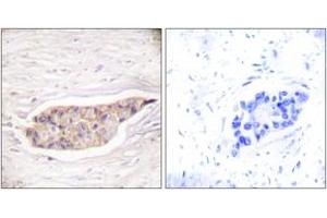 Immunohistochemistry analysis of paraffin-embedded human breast carcinoma tissue, using Annexin A6 Antibody.