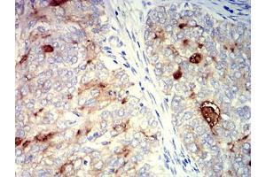 Immunohistochemical analysis of paraffin-embedded cervical cancer tissues using CD227 mouse mAb with DAB staining. (MUC1 Antikörper  (AA 66-175))