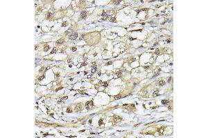 Immunohistochemistry of paraffin-embedded human liver cancer using PSMB3 antibody (ABIN6131929, ABIN6146317, ABIN6146318 and ABIN6225280) at dilution of 1:100 (40x lens). (PSMB3 Antikörper  (AA 1-205))