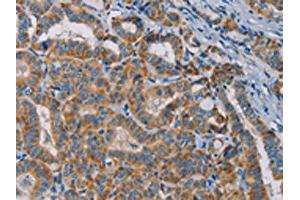 The image is immunohistochemistry of paraffin-embedded Human thyroid cancer tissue using ABIN7131284(TAB3 Antibody) at dilution 1/25.