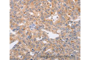 Immunohistochemistry of Human lung cancer using PPP1CB Polyclonal Antibody at dilution of 1:40 (PPP1CB Antikörper)